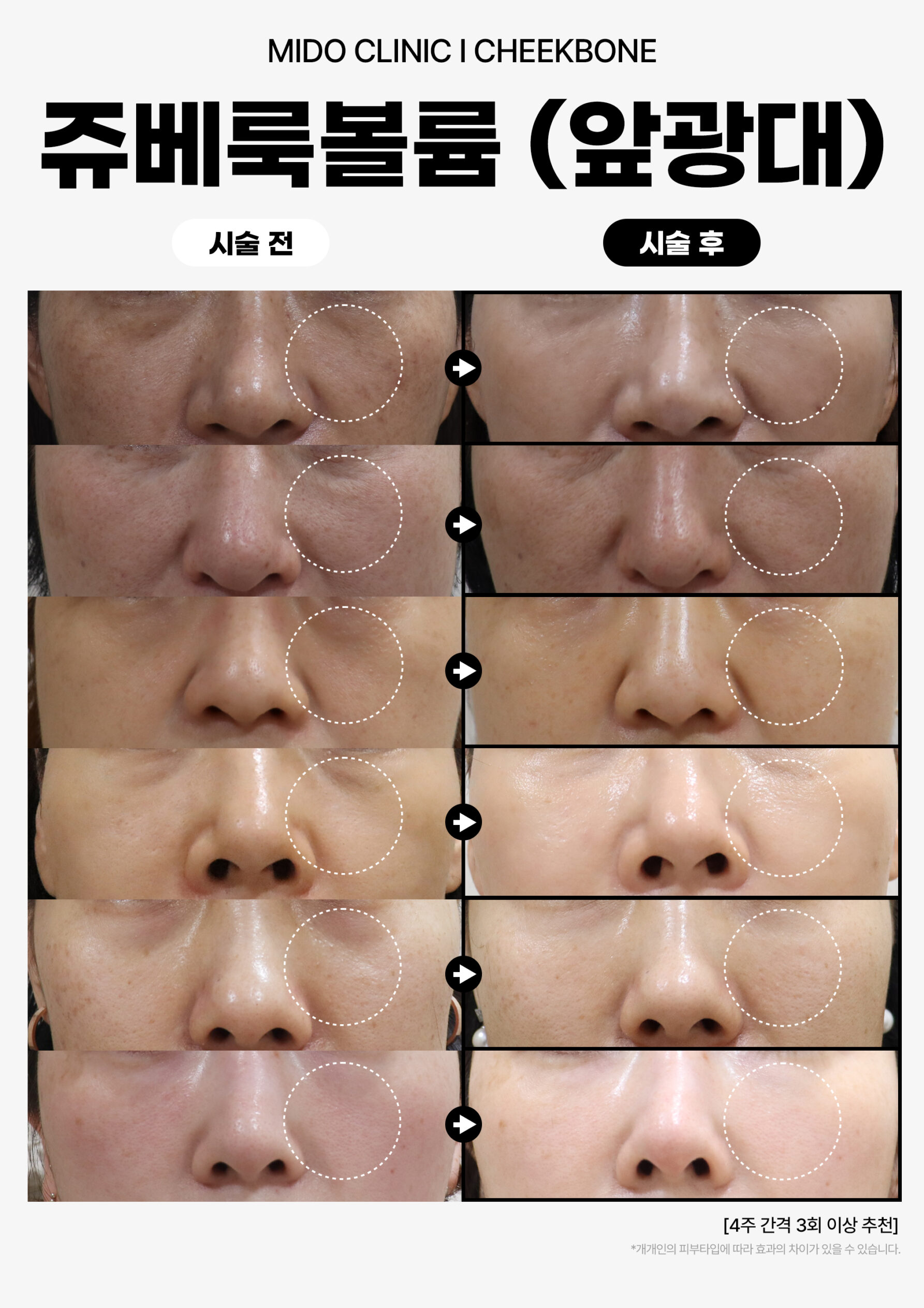 쥬베룩볼륨_앞광대
