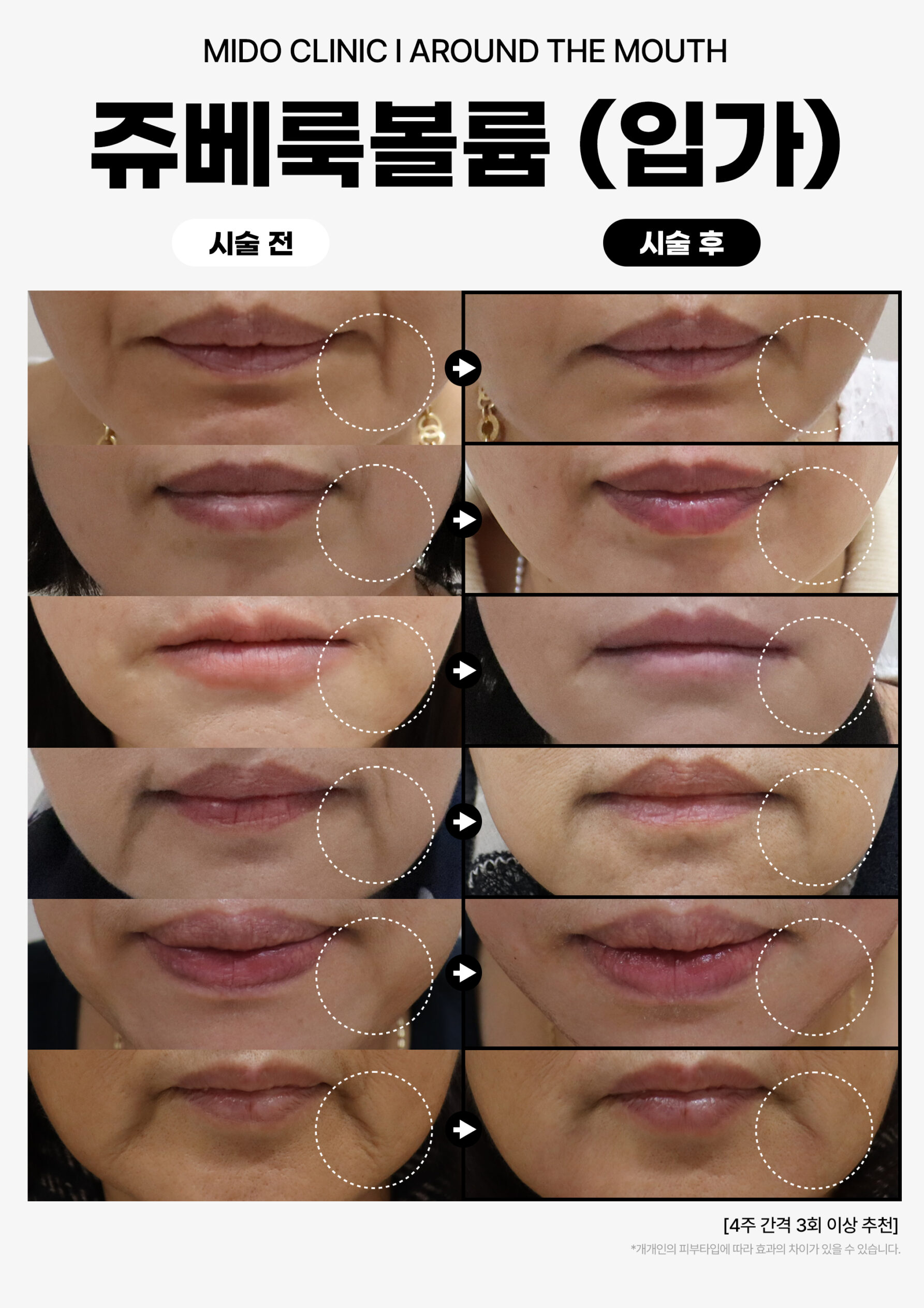 쥬베룩볼륨_입가